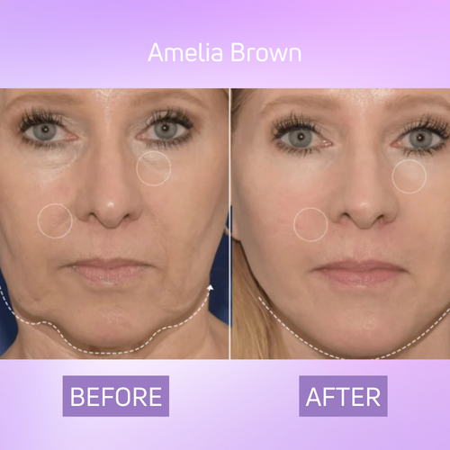 Glowze V Face Lift Patches