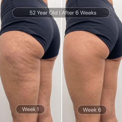 Glowze Anti-Cellulite Massage Kit